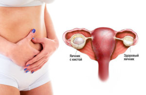 Симптомы проблем с яичниками у женщины