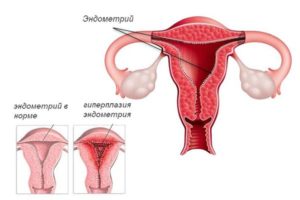 Гиперплазия яичника в менопаузе