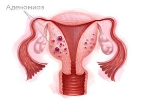 Эндометриоз и аденомиоз при климаксе