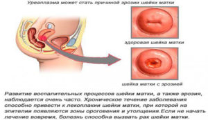 Использование Флуомизина при эрозии шейки матки