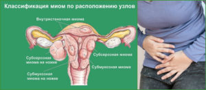 Миома на задней и передней стенках матки