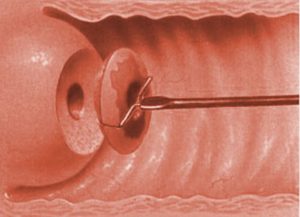 Электроконизация шейки матки при дисплазии