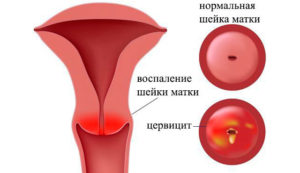 Симптомы воспаления цервикального канала