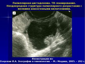 Аденокарцинома яичника: выживаемость на разных стадиях