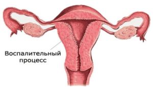 Воспаление матки после родов симптомы