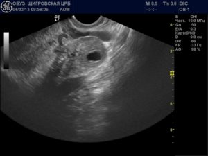 Желтое тело в яичнике при беременности