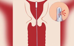 Как делают пайпель биопсию эндометрия