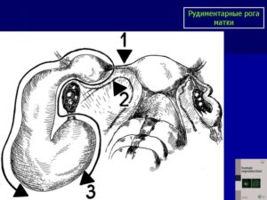 Рудиментарный рог матки