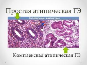 Что называют атипической гиперплазией эндометрия матки