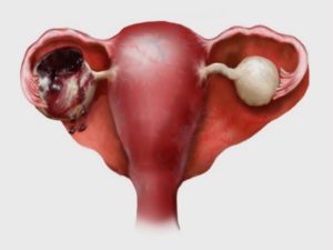 Беременность после удаления эндометриоидной кисты яичника