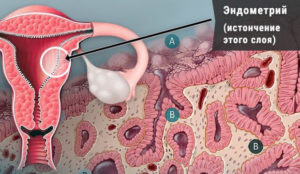 Почему не растёт эндометрий