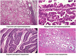 Муцинозная и серозная папиллярная цистаденокарцинома яичника