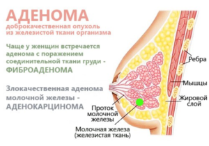 Опухоль доброкачественная в грудине у женщин