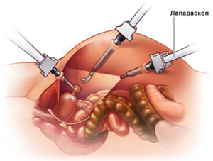 Боли после лапароскопии