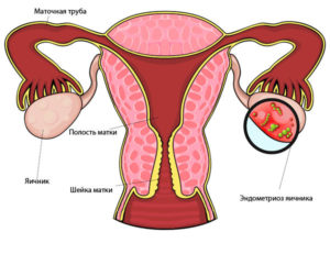 Эндометриома левого яичника что это такое