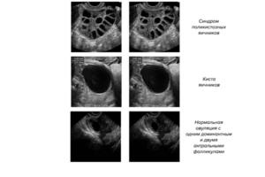 Мультикистоз яичников: лечение