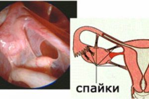 Тазовые перитонеальные спайки у женщин что это