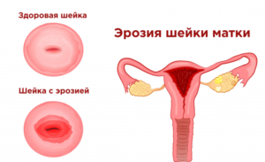 Психосоматика и эрозия шейки матки