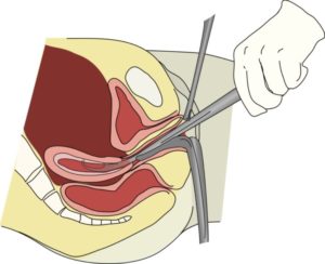 Кровотечение после выскабливания полости матки