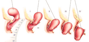 Опущение матки в гинекологии