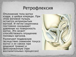 Как понять ретроверсия матки