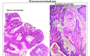 Прогноз при плоскоклеточном раке шейки матки