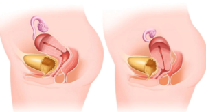 Опущение матки в гинекологии