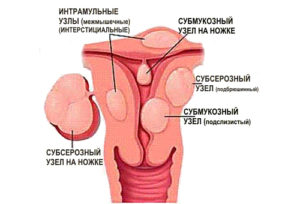 Интерстициальный узел что это такое