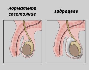 Гидроцеле осумкованное что это