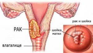 Выделения при раке матки