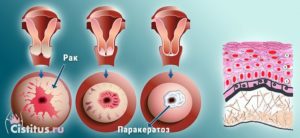 Гиперкератоз в гинекологии что это такое