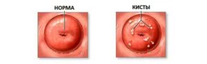 Признаки и симптомы кисты на шейке матки