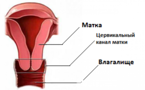 Парацервикальные кисты