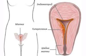 Что называют очаговой гиперплазией эндометрия