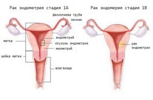 Симптомы и признаки рака эндометрия матки