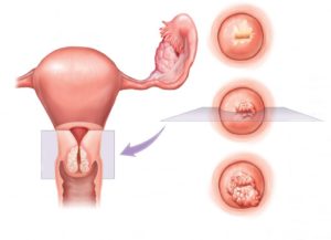 Карцинома шейки матки