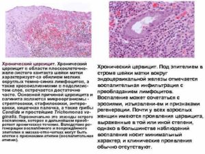 Что называют хроническим цервицитом шейки матки