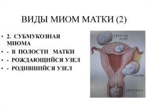 Субмукозная разновидность миомы матки