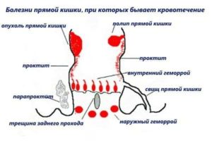 Боль при овуляции отдает в прямую кишку