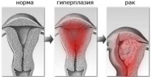 Что такое гиперплазия эндометрия