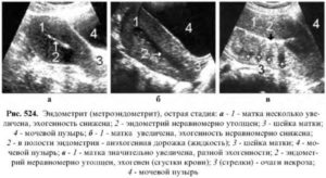 Утолщение стенок матки что это такое