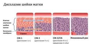 Лечение пищевой содой дисплазии шейки матки