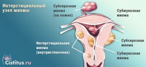 Миома на задней и передней стенках матки