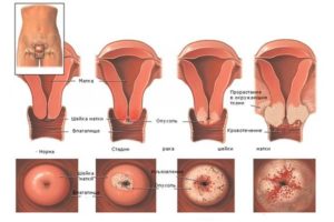 Чем опасна эрозия шейки матки у нерожавших девушек