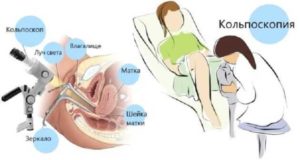 Можно ли делать кольпоскопию при месячных