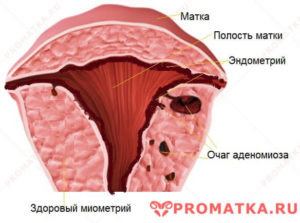 Что такое очаговый аденомиоз матки