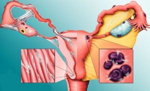 Причины возникновения эндометриоза у женщин