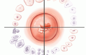 Чем опасна эрозия шейки матки