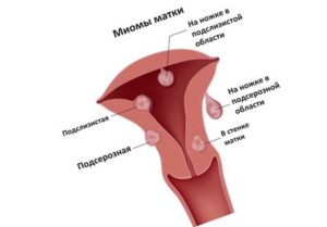 Миома матки и эндометриоз