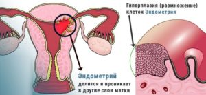 Лечение гиперплазии эндометрия народными средствами